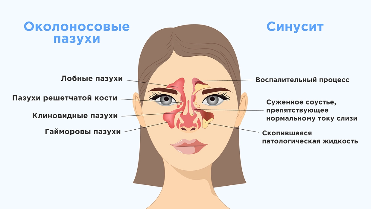 Синусит - симптомы, причины, диагностика и методы лечения